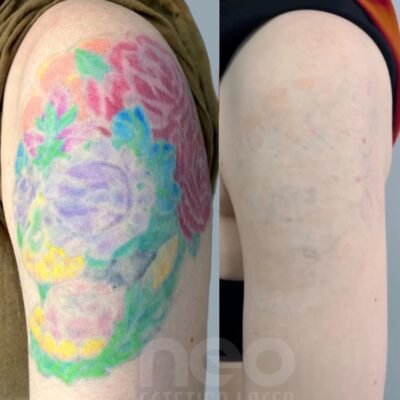 Remoción de tatuajes y micropigmentación